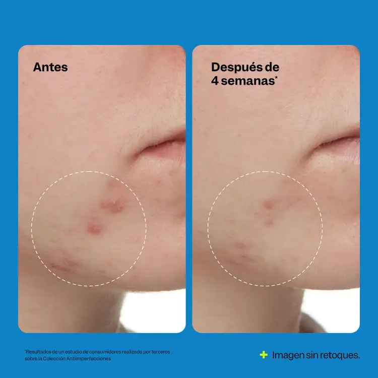 Acne Exfoliating Toner - Tónico Exfoliante para Acné, ácido salicílico + niacinamida - 120 ml